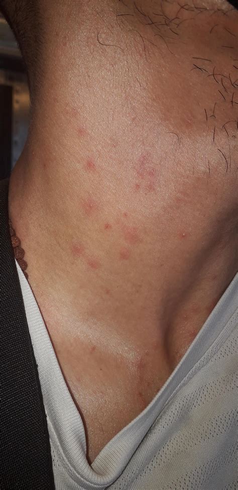 Itchy Rash On Chest Neck Help Please R Diagnoseme