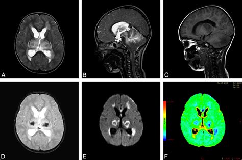 Acute Necrotizing Encephalopathy In A Child During The 2009 Influenza A