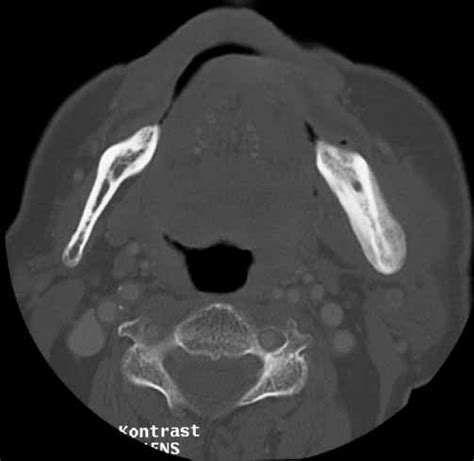 Osteomyelitis With Proliferative Periostitis Axial Ct Section Through