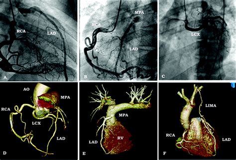 Anomalous Origin Of The Left Anterior Descending Artery From The