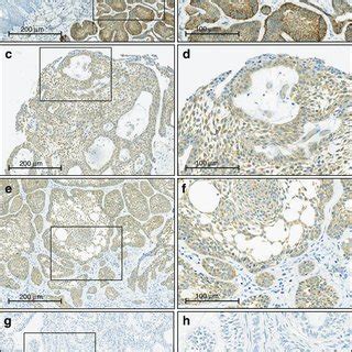 Immunohistochemical Expression Of Brafv E In Odontogenic Lesions A