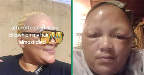 Mzansi Woman Shows Disturbing Hair Bleaching Aftermath On Tiktok Says She Almost Died Briefly