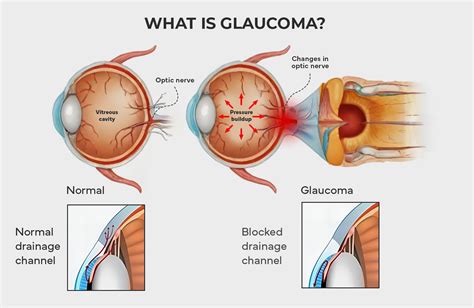 Understanding Glaucoma: Symptoms, Causes, Treatments | Atlus