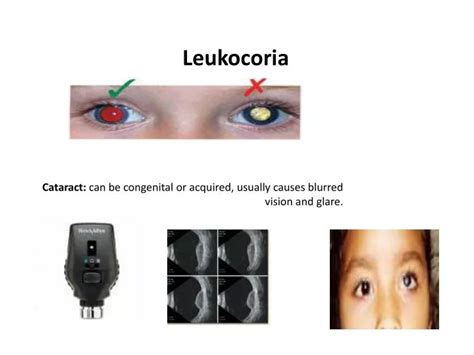 PPT - Leukocoria PowerPoint Presentation - ID:2460389