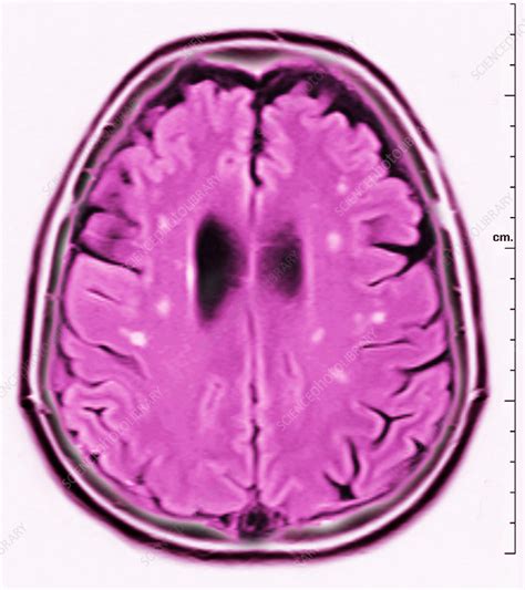 Brain MRI, White Matter Hyperintensities - Stock Image - C027/1275 ...