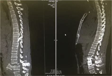 Sagittal Computed Tomography Scan Of The Thoracolumbar Spine The Left