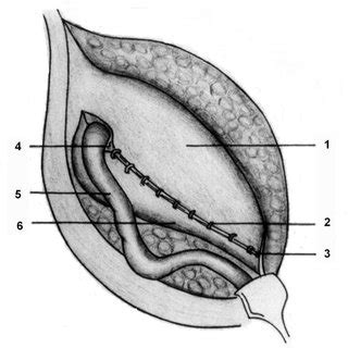 Section of inguinal canal at rest. 1) External oblique aponeurosis, 2 ...