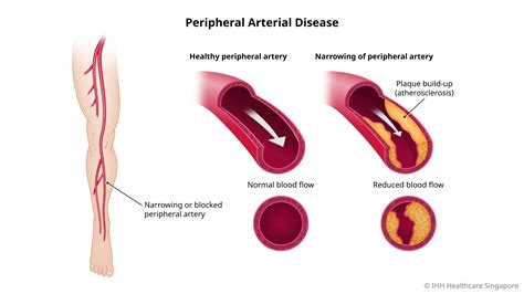 Peripheral Arterial Disease Pad Symptoms And Causes Parkway Shenton