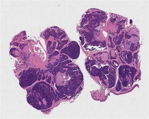 What Are Your Ddx For This Lesion Malignant Spiradenoma Kiko Xp