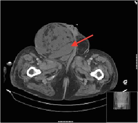 An Unusual Inguinoscrotal Hernia With Renal Involvement Bmj Case Reports