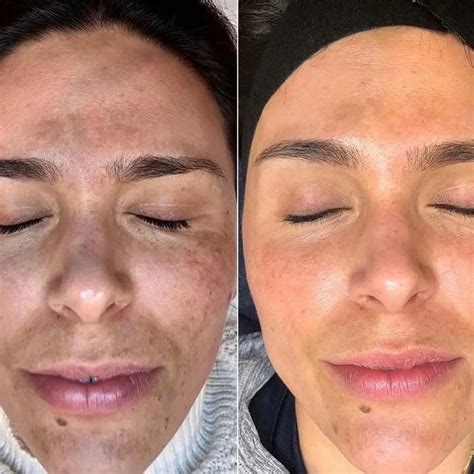 Mild Chemical Peel Before After