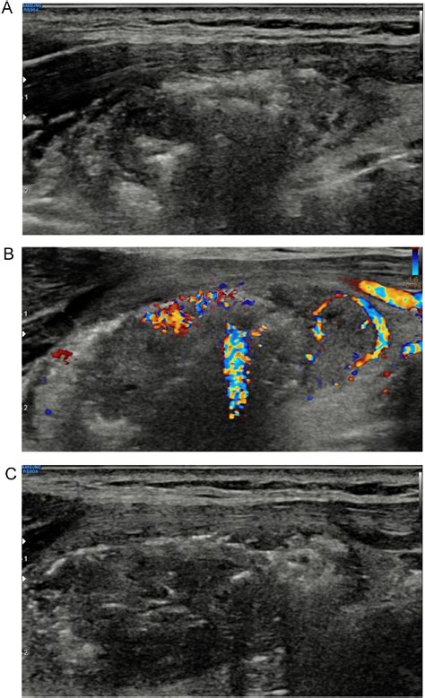 Advanced Techniques For Thyroid Nodule Radiofrequency Ablation Techniques In Vascular