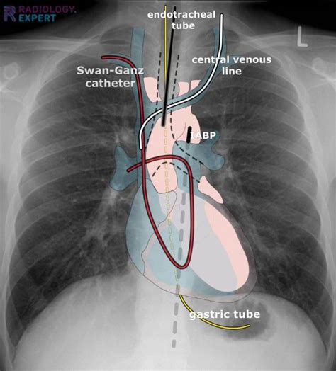 What Is The Point Of A Chest X Ray At Richard Fleetwood Blog