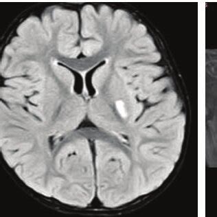 A Axial Diffusion Weighted Image Of The Brain Shows Hyperintensity In