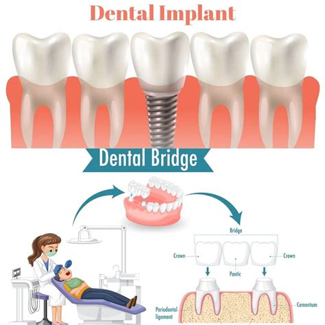 Tooth Bridge Vs Implant Dental Bridge Cost 2024 Pros Cons