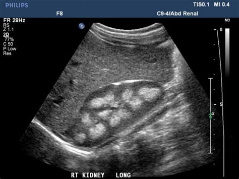 Medullary Nephrocalcinosis Radrounds Radiology Network