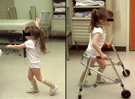 Cerebral Palsy Orthoinfo Aaos