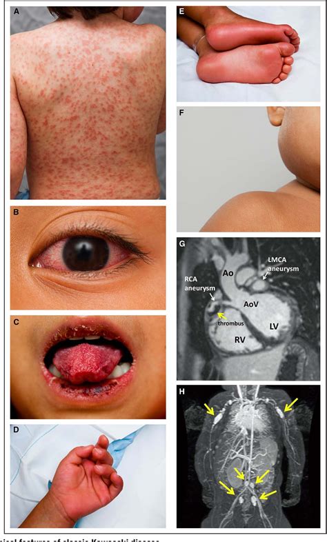 Mucocutaneous Lymph Node Syndrome Semantic Scholar