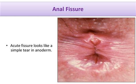 Management Of Benign Ano Rectal Disorders Acg Clinical Guideline Ppt