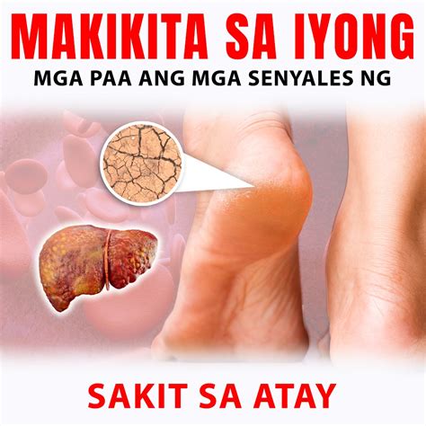 pinapakita ng iyong paa ang senyales ng sakit sa atay  check mabuti