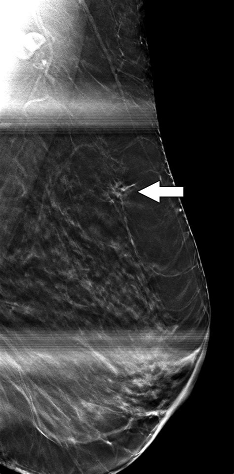 Comparison Of Outcomes For One View Asymmetries Recalled From Digital