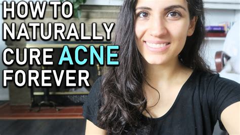 How To Naturally Cure Acne Forever Youtube