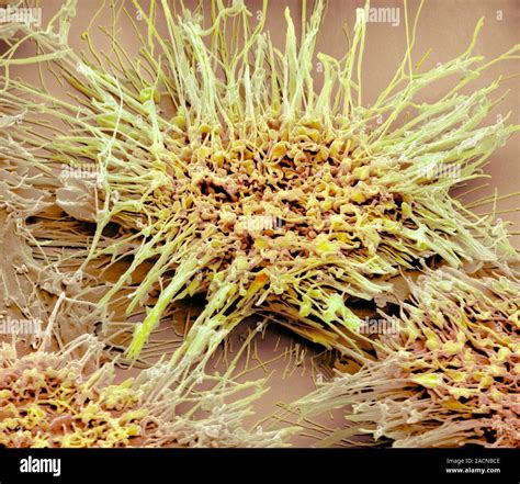 Vaginal Cancer Cells Coloured Scanning Electron Micrograph Sem Of