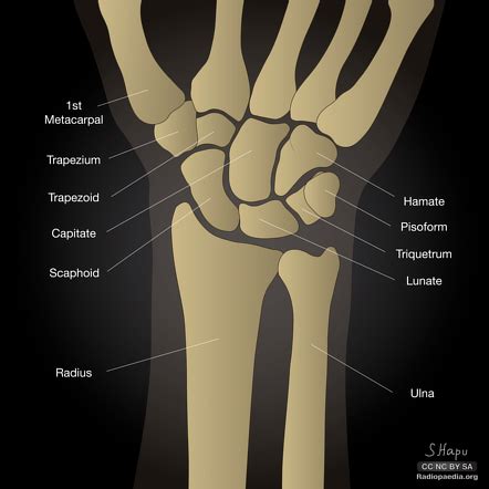 Wrist Radiograph An Approach Radiology Reference Article