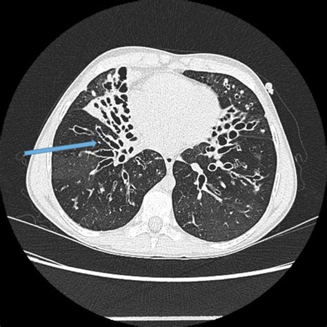 Radiology Bronchiectasis