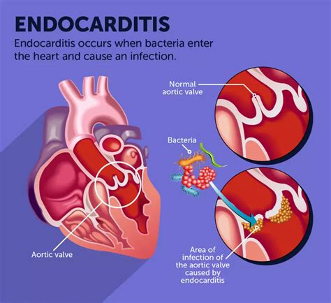 Endocarditis Symptoms Testing And Treatment Myheartdiseaseteam