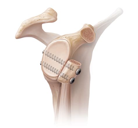 Arthrex - Latarjet/Coracoid Process Transfer for Glenoid Deficiency