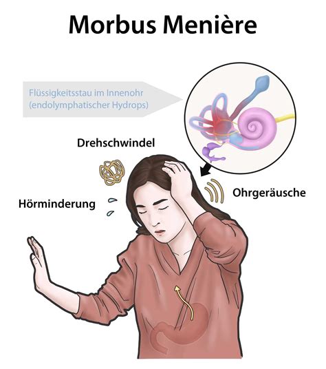 Welche Symptome treten bei Morbus Menière auf