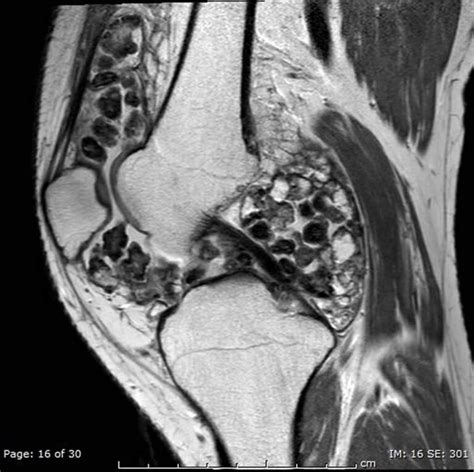 Synovial osteochondromatosis causes, symptoms, diagnosis, treatment ...