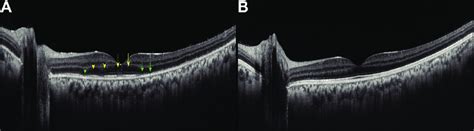 A Swept Source Optical Coherence Tomography Ss Octa Of The Left Eye