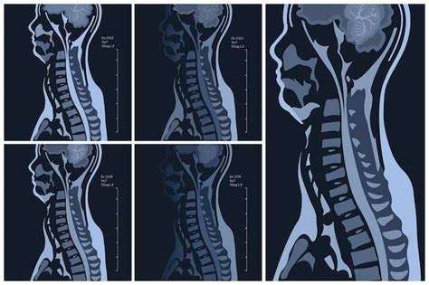 Mri Van De Cervicale Wervelkolom Met En Zonder Contrast Mri Met