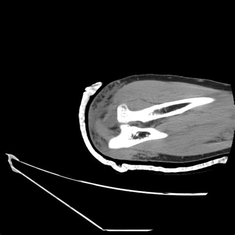 Coronoid Process Fracture Type Iii O Driscoll Classification Image