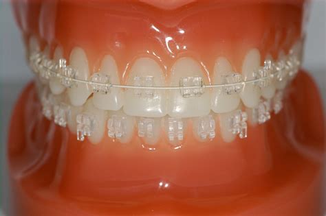 Types Of Orthodontic Braces