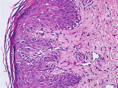 Vacuolar Alterations Of The Basal Layer Necrotic Keratinocytes And A