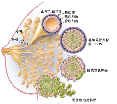 乳腺导管原位癌术后是否选择放疗