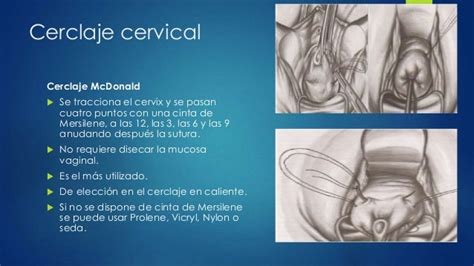 Procedimientos Quirurgicos En Cervix Uterino