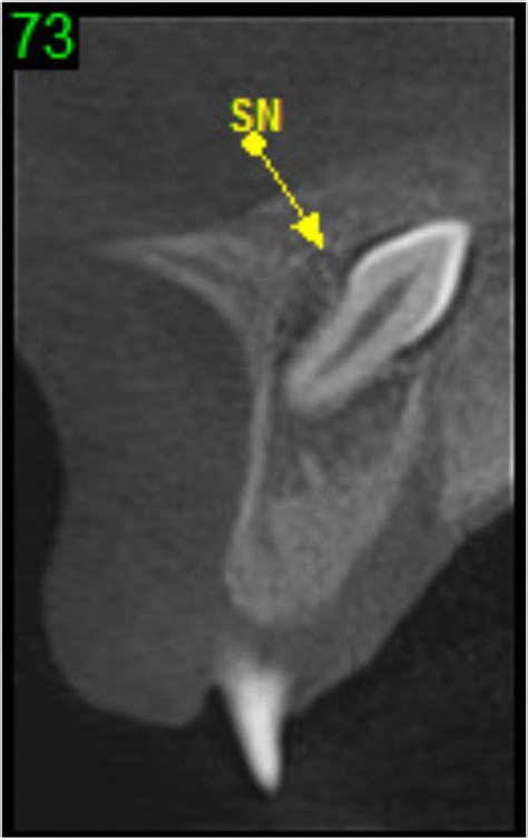 CBCT Slice Showing A Mesiodens In An Inverted Position Class 5 4