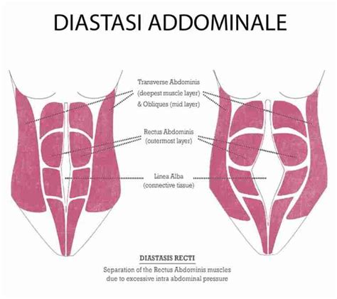 Diastasi addominale cosè Centro Sarai