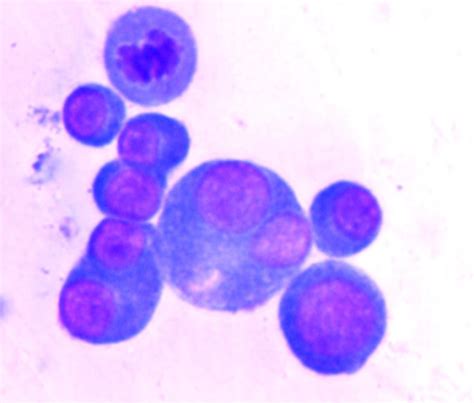 Plasma Cells Pleural Fluid