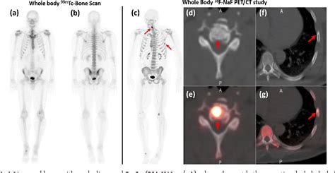 Figure From F Naf Pet Ct Imaging Versus Mtc Mdp Scintigraphy In