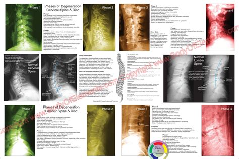 Phases Of Spinal Degeneration Poster 24 X 36