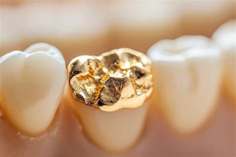 Dental Gold Fillings Used To Fill Cavity On Tooth Stock Image Image