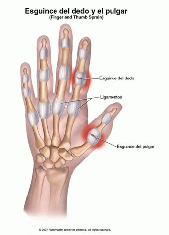 Esguince Del Dedo De La Mano Fisioterapia Deportiva