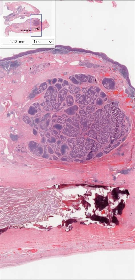 Neuroendocrine Tumor In Teratoma Torento Pathology Website Kiko Xp