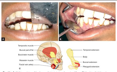 Figure From Versatility Of Pedicled Buccal Fat Pad In The Treatment