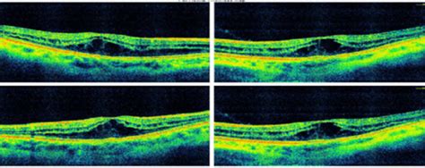 October Retinal Review Oomc